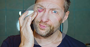 Portrait of a middle-aged man after the attack. He looks in the mirror and touches his bruise.