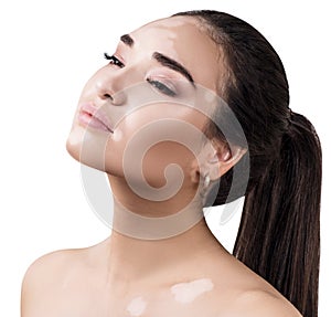 Portrait of sensual woman with vitiligo disease.