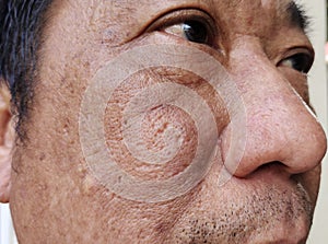 The Flabby wrinkled blemishes and Dullness dark spots on the face. photo