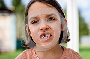 Portrait of toothless child girl missing milk and permanent teeth