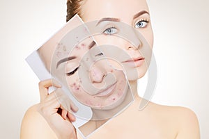 Portrait of woman with clean skin holding portrait with pimpled