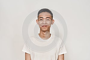 Portrait of young asian man with problematic skin and hyperpigmentation on his face smiling at camera isolated over