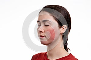 Portrait of a young Caucasian woman with closed eyes with rosacea on her cheeks. White background. Copy space. The concept of