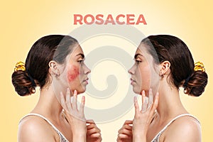 Before and after. Portrait of a young woman with rosacea on her cheek, side view. Beige background. Side view. Concept of rosacea