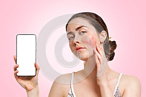 Portrait of a young woman showing redness and inflamed blood vessels on her cheeks, and holding a smartphone in her hand. Pink