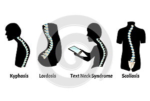 The position of the spine with lordosis, kyphosis. Text Neck Syndrome. Spinal curvature, kyphosis, lordosis, scoliosis