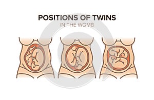 Position of twins in the womb. Pregnancy