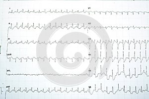 A positive stress induced myocardial ischemia with significant horizontal ST depression changes in the stress ECG