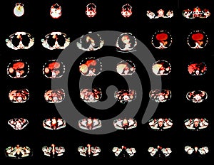 positron emission tomography