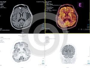 Positron emission tomography (PET) CT scan of HEAD and NECK