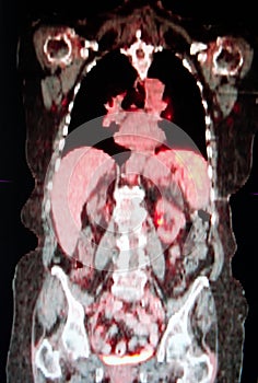 Positron emission tomography photo