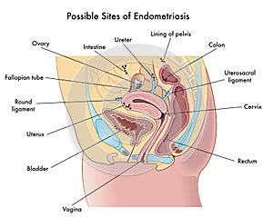 Possible sites of endometriosis photo