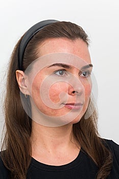 Post-acne on the patient`s face. Remission of papulopustular rosacea