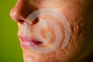 Post-acne, scars and red festering pimples on the face of a young woman. concept of skin problems and harmonic failure