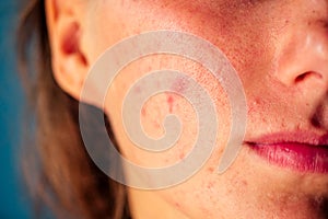 Post-acne, scars and red festering pimples on the face of a young woman. concept of skin problems and harmonic failure