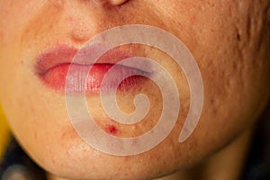 Post-acne, scars and red festering pimples on the face of a young woman. concept of skin problems and harmonic failure