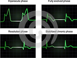 Post miocardial infarction phases photo