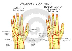 Post-traumatic ulnar artery aneurysm located adjacent to the hamate bone