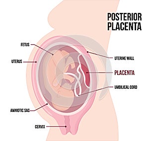 Posterior Placental previa. Usual anatomical Placenta Location During Pregnancy. photo