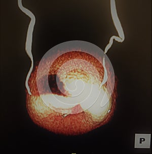 Posterior view 3d ct cystogramm ureters photo