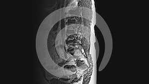 Postoperative voluminous MRI of female organs for the detection of metastases