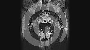 Postoperative voluminous MRI of female organs for the detection of metastases