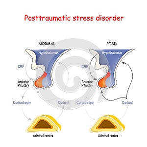 Posttraumatic stress disorder photo