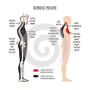 Kyphotic posture. The side view shows deformation of rounded shoulders, spine curvature, pelvis rotation, stretched and weakened, photo