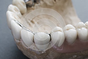Practical sample of dental implantation close-up