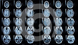 Pre/Post Contrast Brain MRI