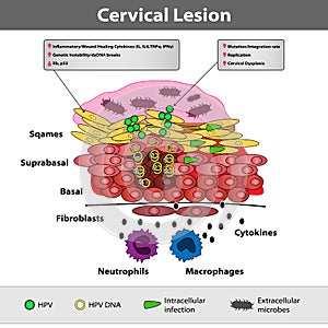 A precancerous cervical lesion. Abnormal cervical appearance. Medical vector illustration