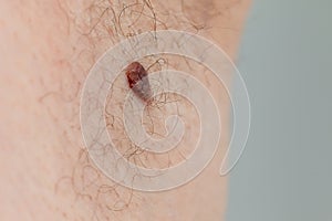 Precancerous mole on armpit - birthmark is potentially cancerous melanoma