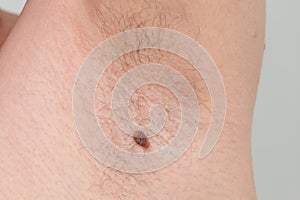 Precancerous mole on armpit - birthmark is potentially cancerous melanoma