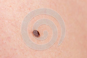 Precancerous mole - birthmark is potentially cancerous melanoma