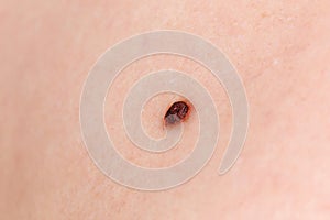 Precancerous mole - birthmark is potentially cancerous melanoma