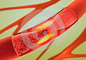 Precipitate and narrowing of the blood vessels - arteriosclerosis photo