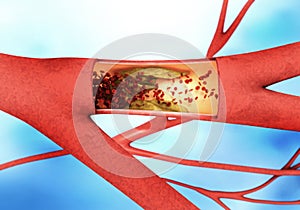 Precipitating and narrowing of the blood vessels - arteriosclerosis photo