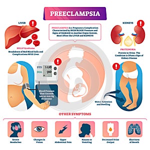 Preeclampsia vector illustration. Labeled pregnancy complication scheme.