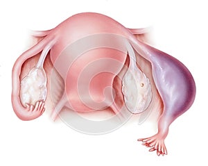 Pregnancy - Ectopic photo