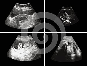 Pregnancy, fetus developing by ultrasound. photo