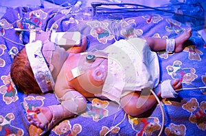 Premature Baby img