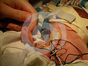 Premature baby with CPAP mask holding finger