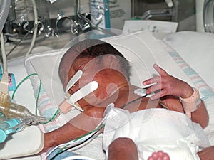 Premature Baby in Hospital