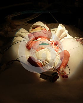 Premature baby One Pound