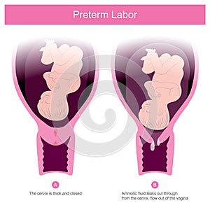The premature birth, can occur in conditions of amniotic fluid leaks out through the cervix .and flow out of the vagina Including photo