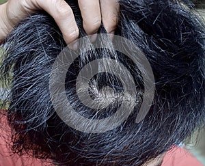 Prematurely gray hair. Southeast Asian young man showing his early grey hair.