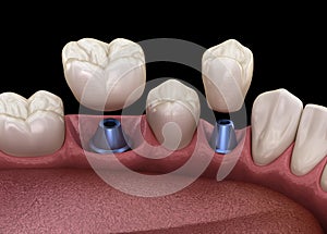 Premolar and Molar tooth crown installation over implant - concept. 3D illustration of human teeth