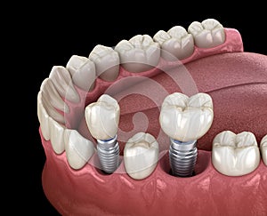 Premolar and Molar tooth crown installation over implant - concept. 3D illustration of human teeth photo