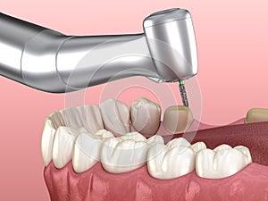 Premolar preparation process for dental crown placement. Medically accurate illustration