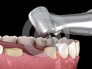 Premolar preparation process for dental crown placement. Medically accurate 3D illustration